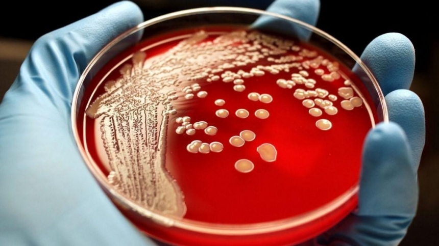 A case of anthrax was recorded in the Kyiv region
