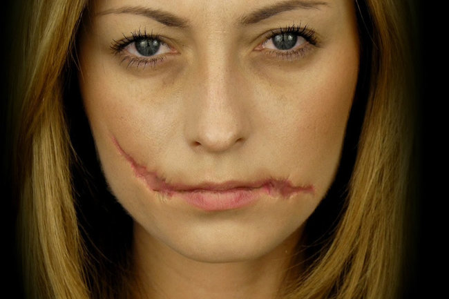 Ukrainians wounded during the war will be able to make free scar correction
