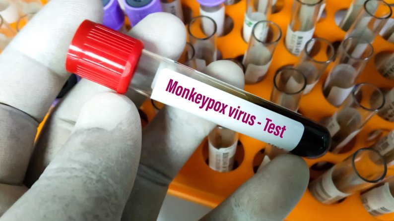 У Великій Британії знайшли новий штам віспи мавп
