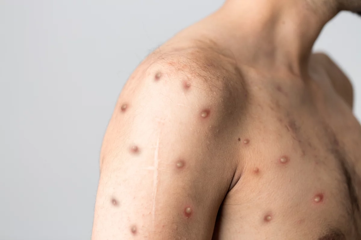 The World Health Organization has declared an emergency due to the spread of monkeypox